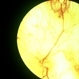 Choroidal atrophy, probable choroideremia Choroidal atrophy, probable choroideremia